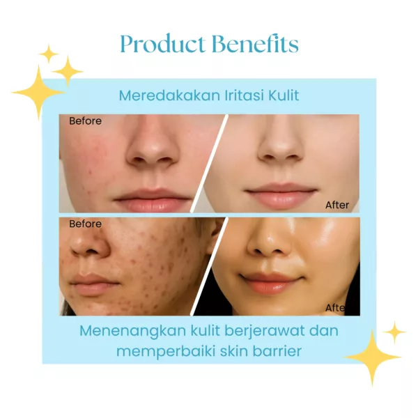 Suklay Daily Glow Set 2in1 Acne Serum & Brightening Toner, Skincare untuk Pencerah Dan Bebas Jerawat