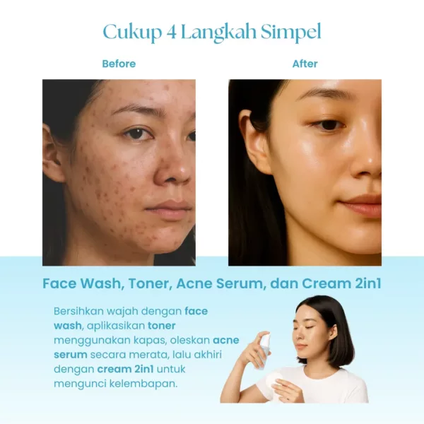 Suklay Anti Acne Paket 4 Set Cegah Jerawat & Repair Barrier (Face Wash + Toner + Serum + Cream)