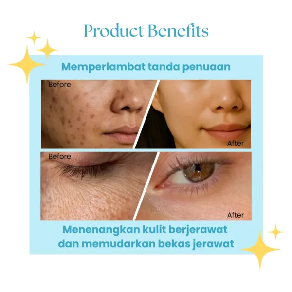 Suklay Paket 2 in 1 Purify & Calm Set – Salmon DNA, Niacinamide, Tea Tree | Redakan Jerawat & Flek | 100ml + 15ml